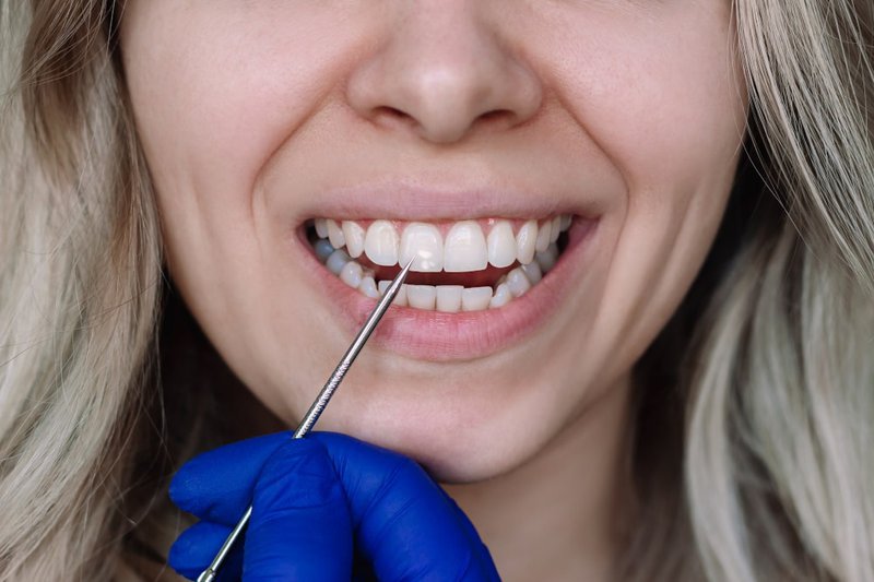 How long do teeth bonding and veneers typically last?