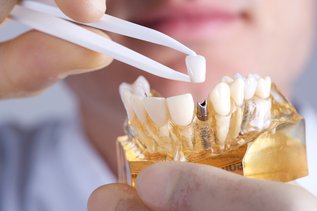 6_Crucial_Tips_for_Getting_All_on_4_Dental_Implants.jpg