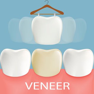 Getting-Veneers-Everything_You-Need-to-Know.jpg