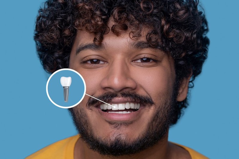 dental-implant