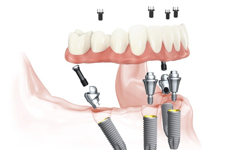 Overview All-on-4 Dental Implant