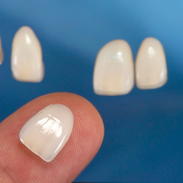 Porcelain, Composite, Palatal, Lumineers, NonPermanent Deciding Which