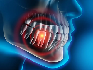 Symptoms of Wisdom Teeth .webp