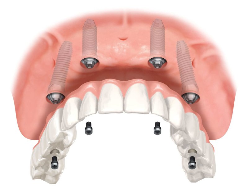 What is all on 4 dental implants