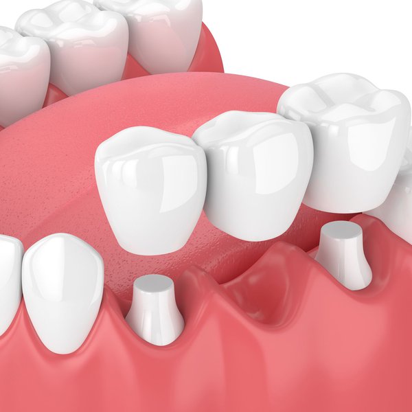Why Do I Need a Dental Bridge?