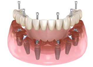 Dentist demonstrating an All-on-X full-arch dental implant restoration with a digital implant-supported prosthesis.