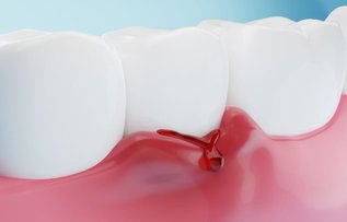 Bleeding gums between teeth when brushing
