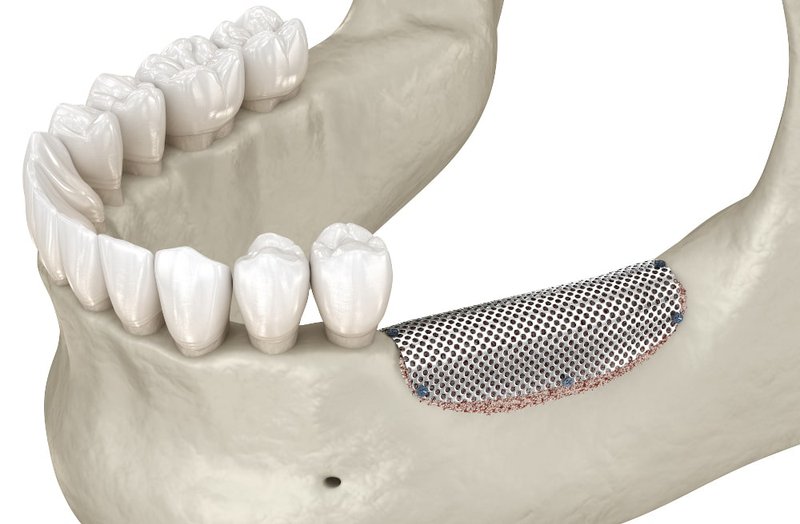 3D illustration of an endosteal dental implant inserted into the jawbone