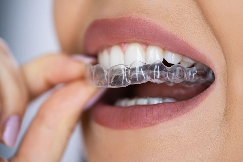 patient wearing invisalign aligners smiling close up