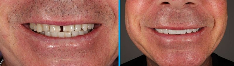 Before and after porcelain veneers on upper front teeth at North York Smile Centre