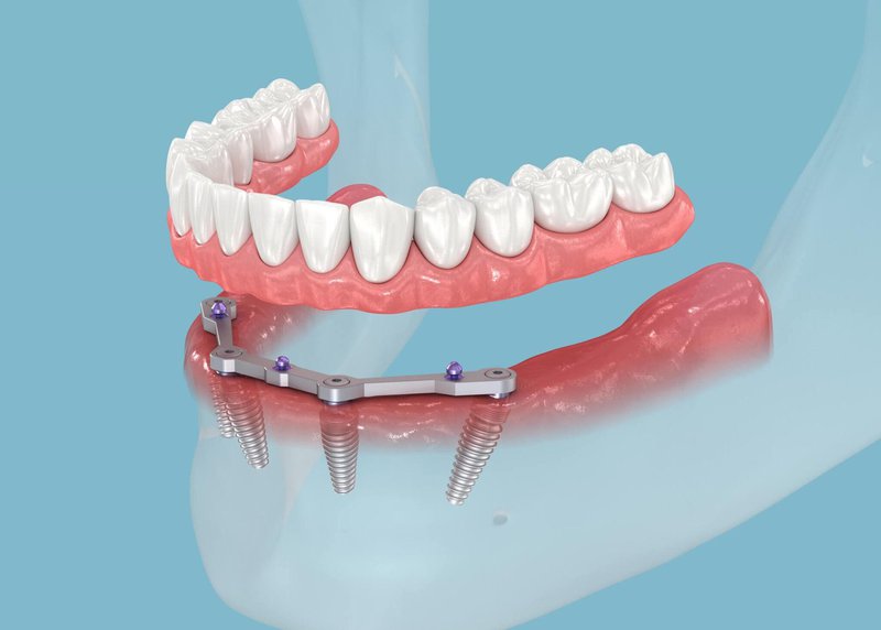 preparation for the All-on-Four implant procedure.jpeg