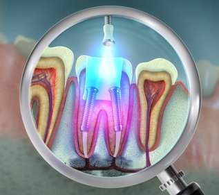 Dentist performing root canal therapy on infected tooth