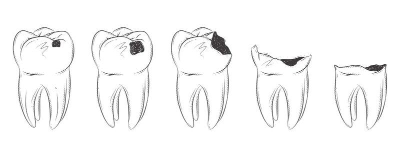 Diagram showing stages of dental cavity development through tooth layers