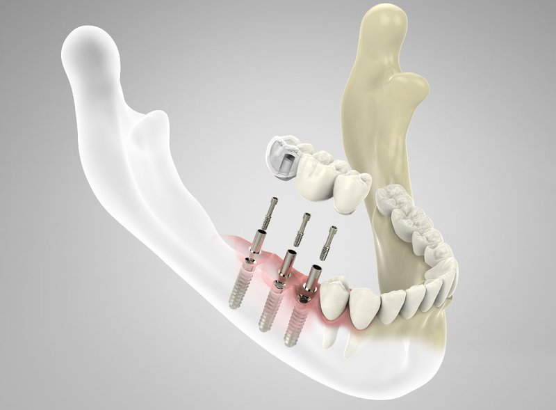 3D rendering of a subperiosteal implant placed above the jawbone