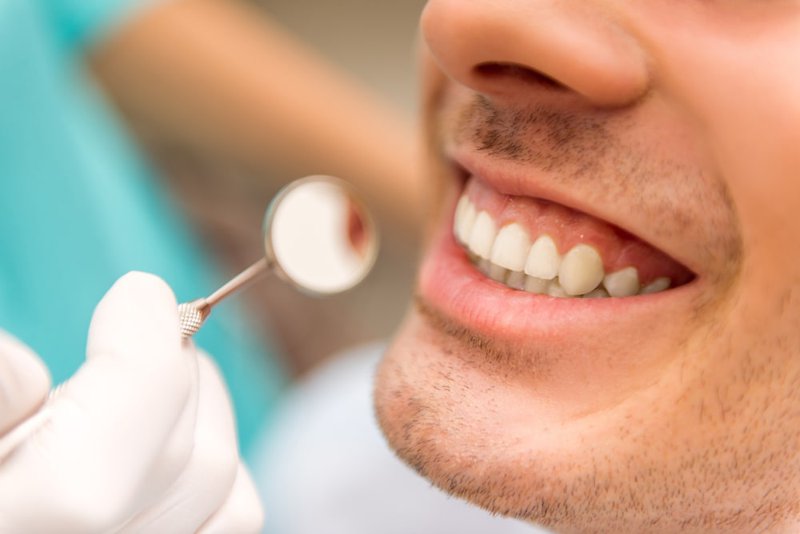 Dental polishing procedure using prophy paste and rubber cup
