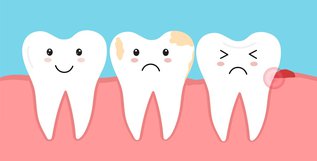 Illustration showing plaque buildup and enamel damage leading to tooth decay